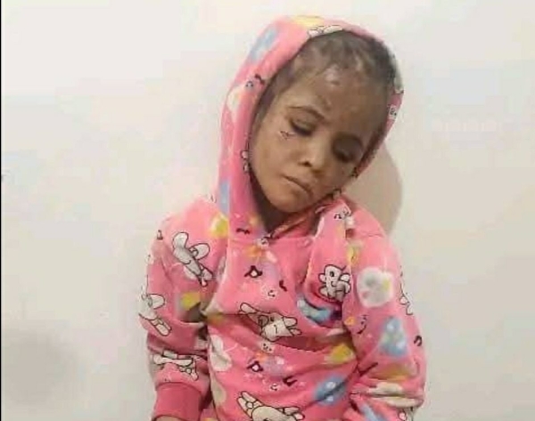 إب.. تعرض طفلة لعمليات تعذيب وعنف أسري مروع