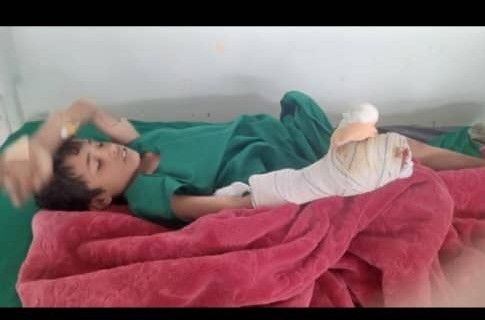 إصابة طفل شرقي صنعاء بمقذوف من مخلفات الحوثيين