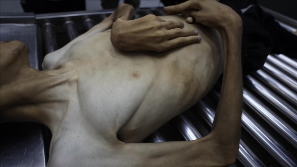 5 وفيات بغزة جراء التجويع الإسرائيلي ترفع الحصيلة لـ387